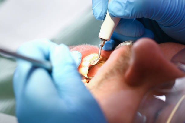Best Emergency Treatment for Dental Infections or Abscesses in Woodward, IA